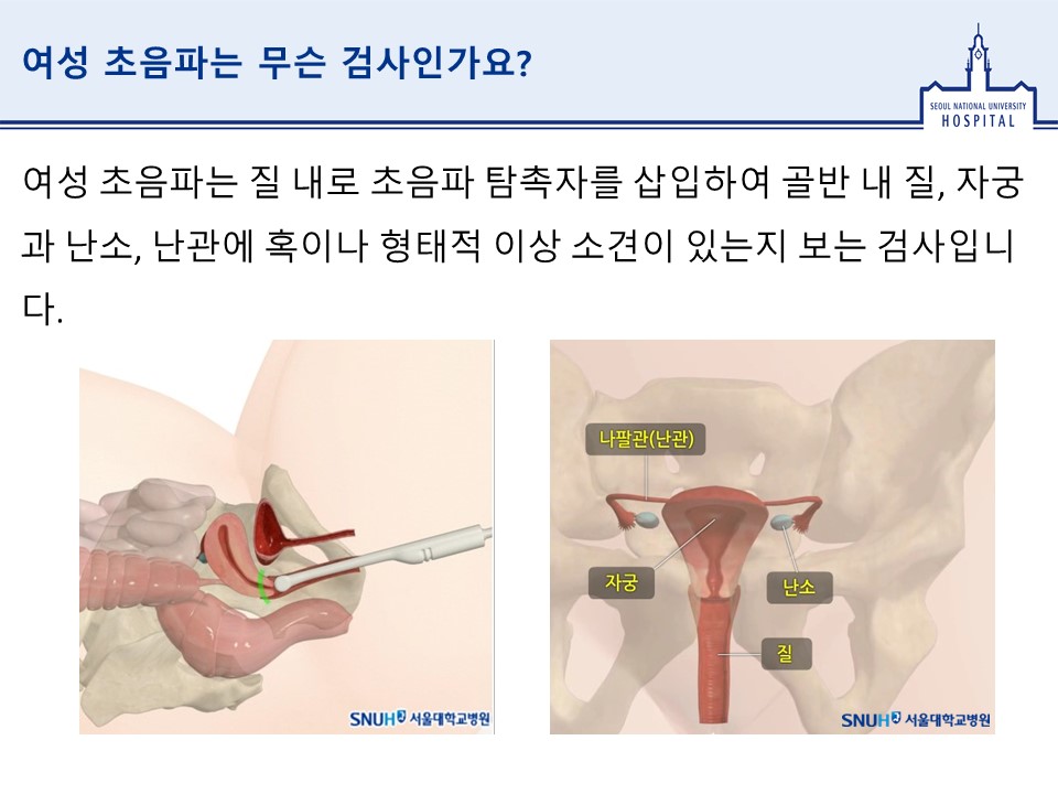 여성 초음파는 무슨 검사인가요여성 초음파는 질 내로 초음파 탐촉자를 삽입하여 골반 내 질, 자궁과 난소, 난관에 혹이나 형태적 이상 소견이 있는지 보는 검사입니다그림1-여성초음파 모습 그림2-부인과 골반 해부학 나팔관(난관) 자궁 난소 질