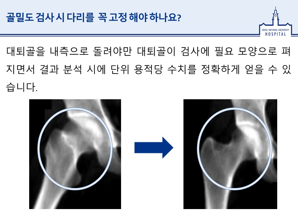 골밀도 검사 시 다리를 꼭 고정 해야 하나요대퇴골을 내측으로 돌려야만 대퇴골이 검사에 필요 모양으로 펴지면서 결과 분석 시에 단위 용적당 수치를 정확하게 얻을 수 있습니다. 그림- 자세에 따른 고관절 모양